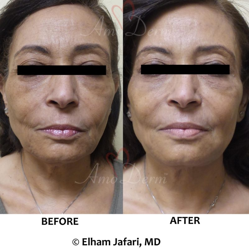 Liquid Facelift in forehead, crow&#039;s feet &amp; frown lines &amp; filler in cheeks, nasolabial folds &amp; marionette lines