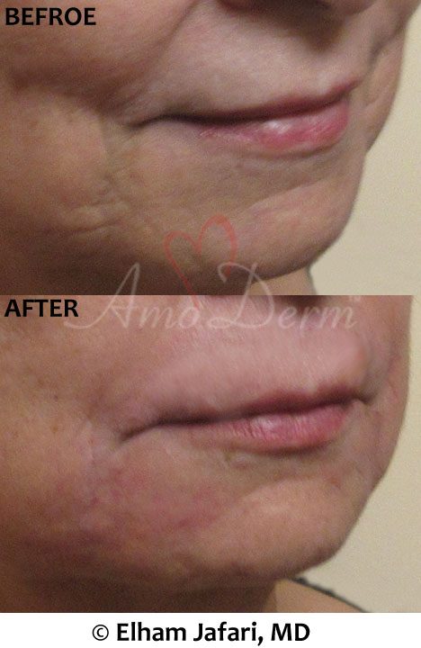 Marionette Line Treatments - before and after picture with real result at Amoderm IRVINE, Orange County
