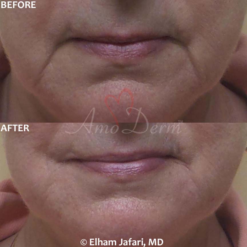 Lines Cosmetic Treatments Before & After Pictures