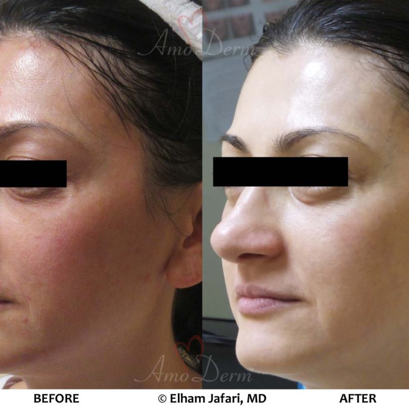 MicroLaser Peel