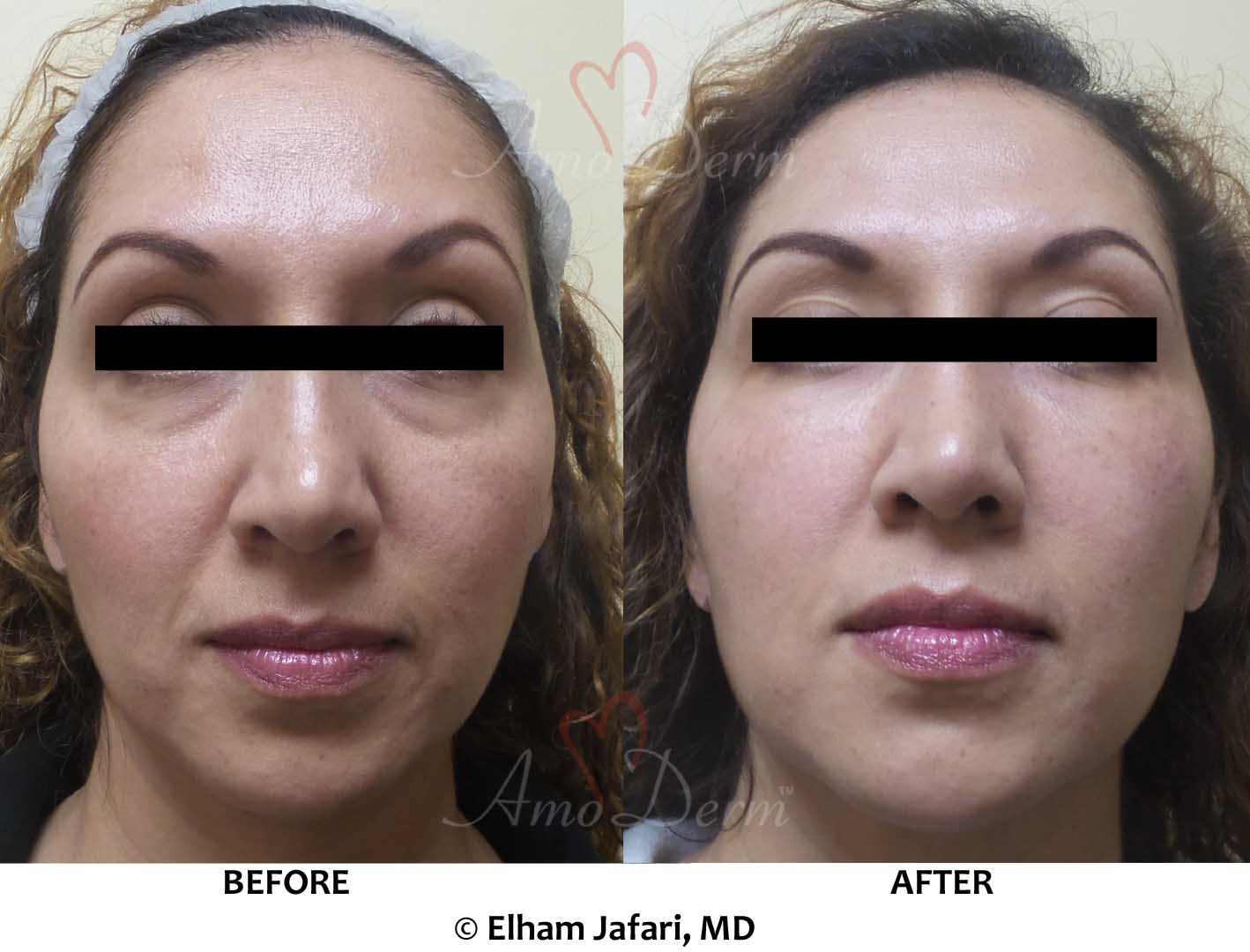 Midface Restoration Cosmetic Treatments Before & After Pictures