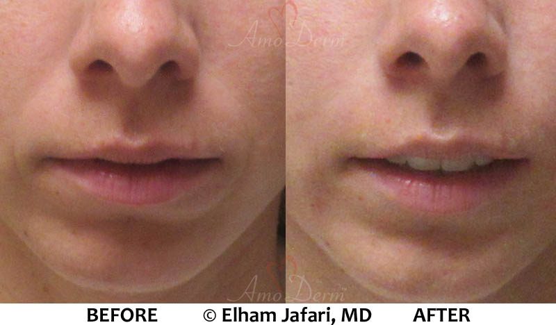 Naselabial Folds