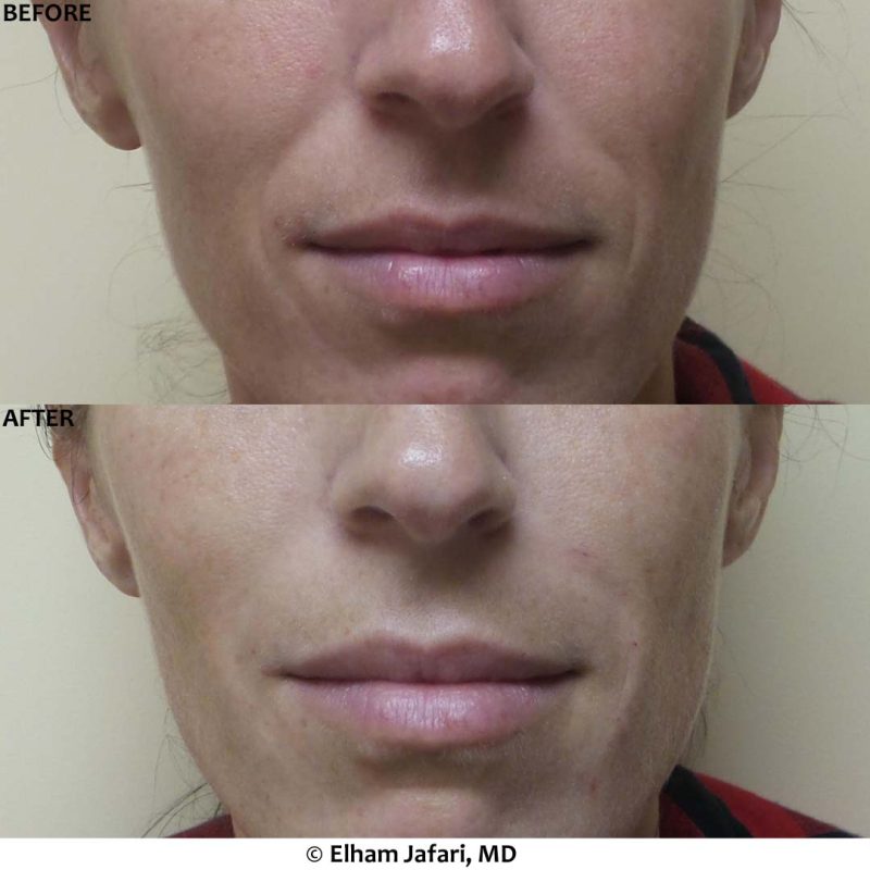 Nasolabial Fold - Before &amp; After Gallery Real Results at Amoderm