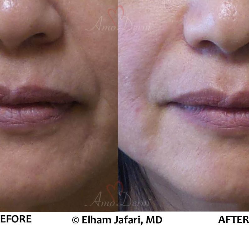 Nasolabial Folds