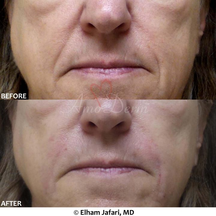 Nasolabial Folds