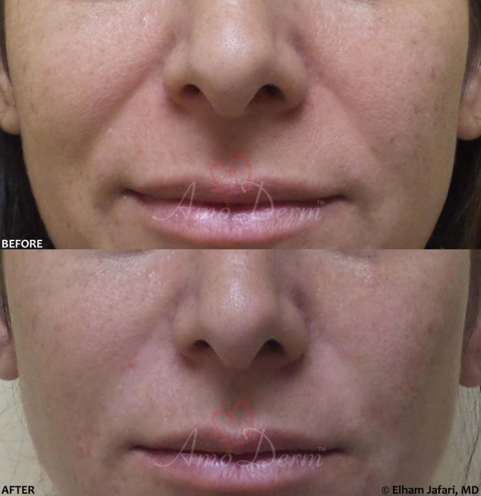 Nasolabial Folds