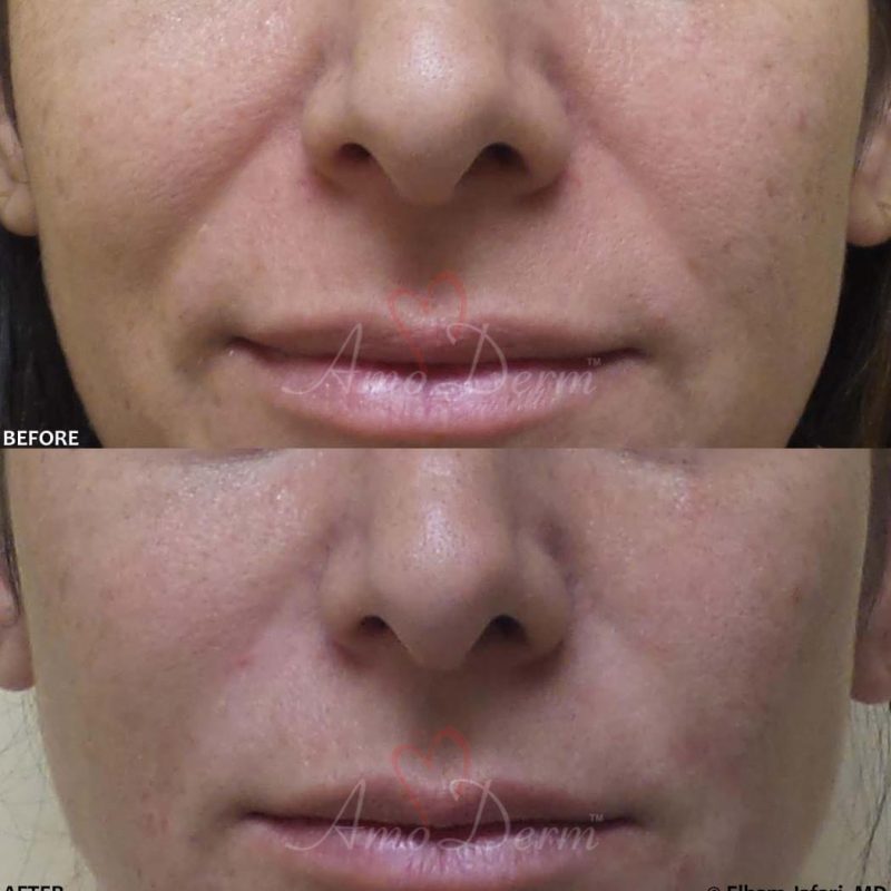 Nasolabial Folds