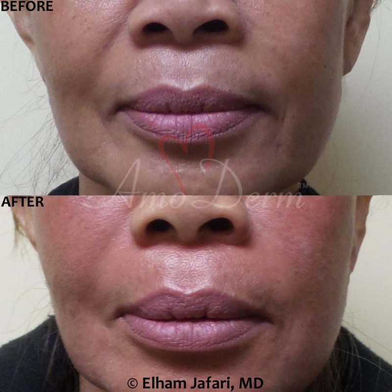 Treatment of nasolabial folds as part of non-surgical facelift