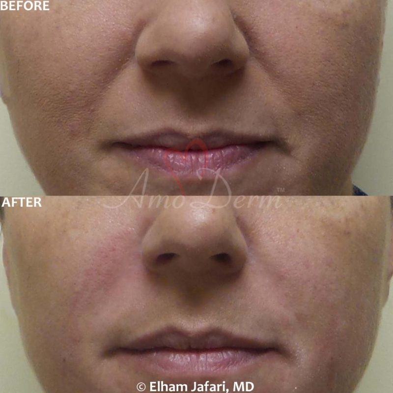 Treatment of nasolabial folds as part of non-surgical facelift