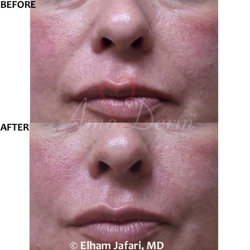 Nasolabial Folds