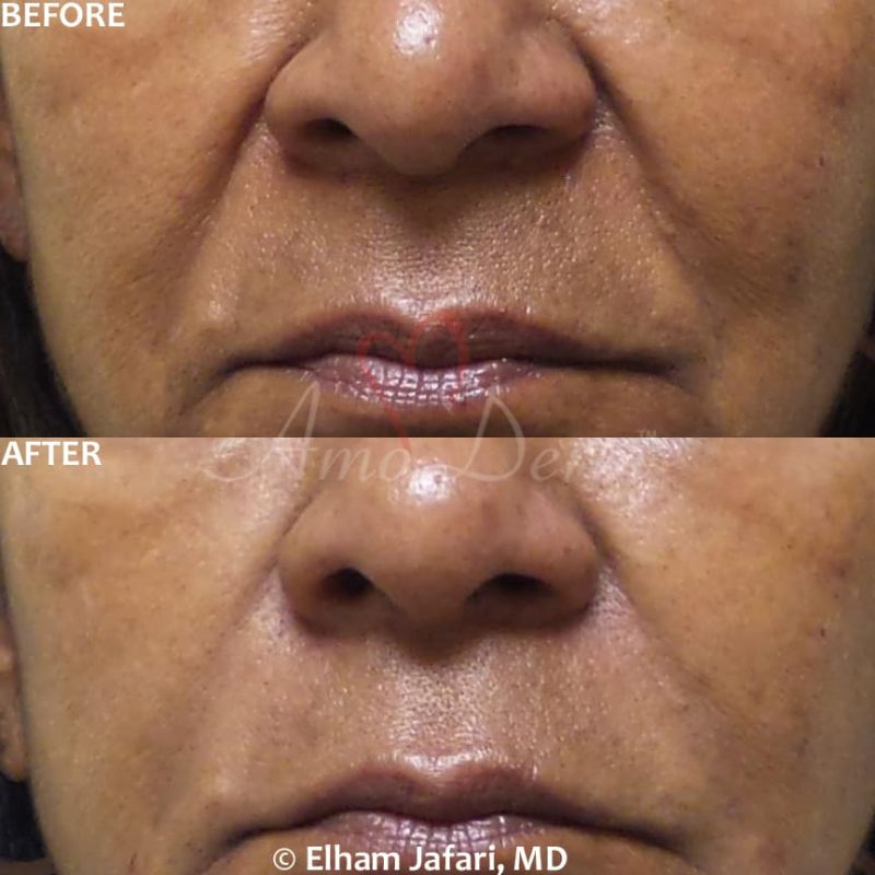 Treatment of nasolabial folds (laugh lines) as part of non-surgical facelift (AKA Liquid Facelift)