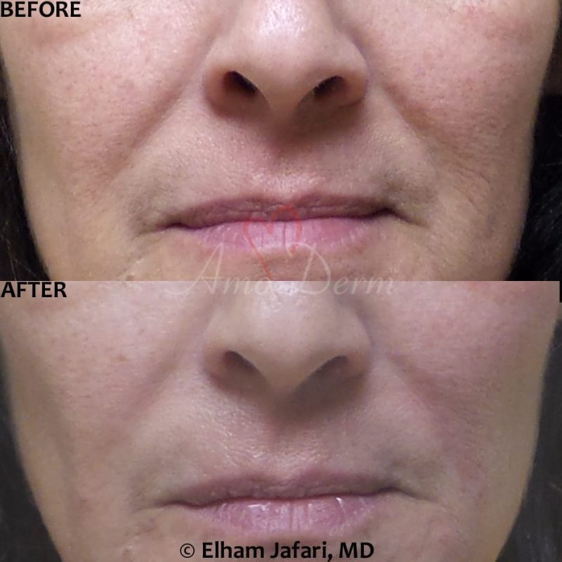 Treatment of nasolabial folds as part of non-surgical facelift