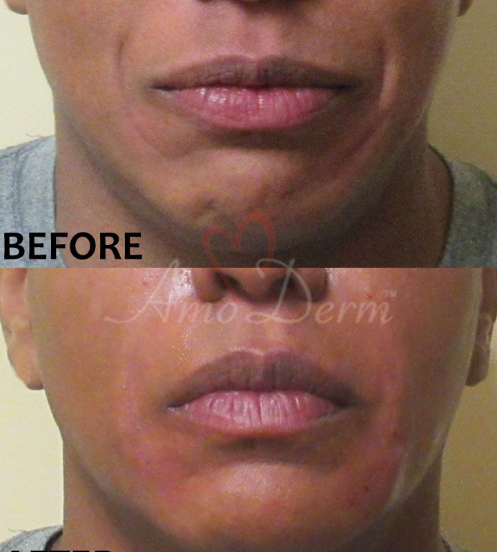 Nasolabial Folds