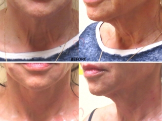 Thread Lift and Neck Rejuvention