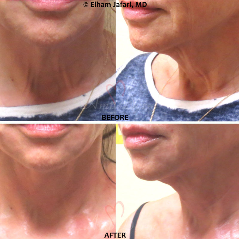 Thread Lift and Neck Rejuvention