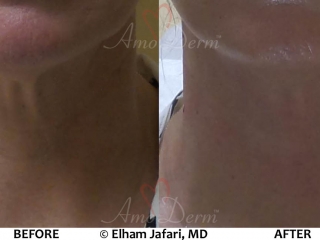 Neck Rejuvenation - Before &amp; After Gallery Real Results at Amoderm