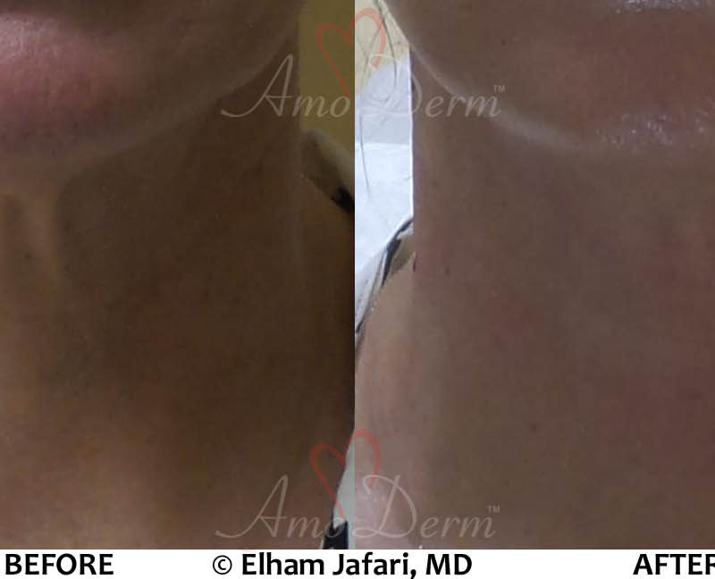 Neck Rejuvenation - Before &amp; After Gallery Real Results at Amoderm