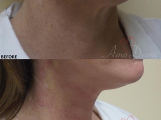 Neck Rejuvenation - Before &amp; After Gallery Real Results at Amoderm