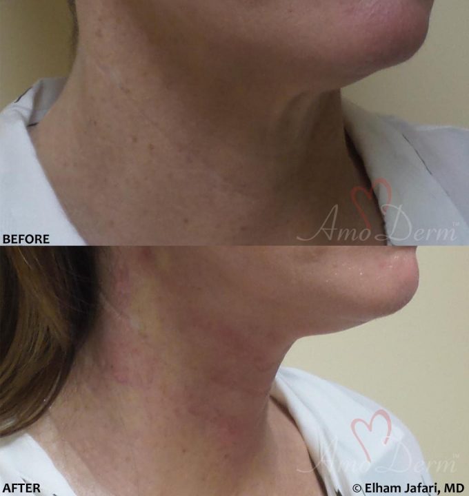 Neck Rejuvenation - Before & After Gallery Real Results at Amoderm