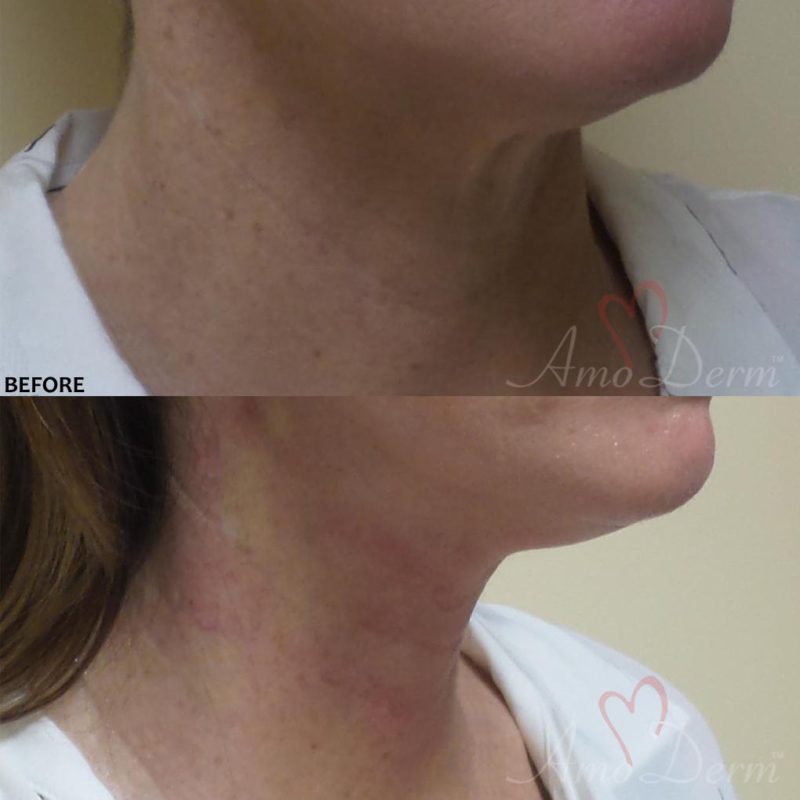 Neck Rejuvenation - Before &amp; After Gallery Real Results at Amoderm