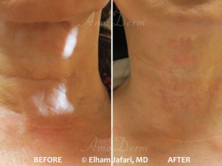 Neck Rejuvenation
