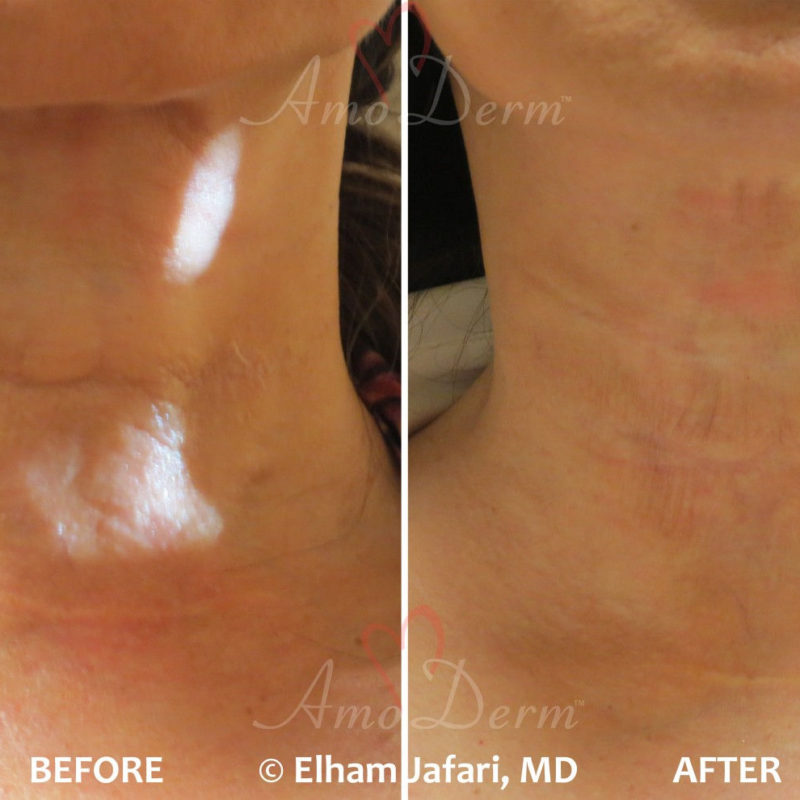 Neck Rejuvenation