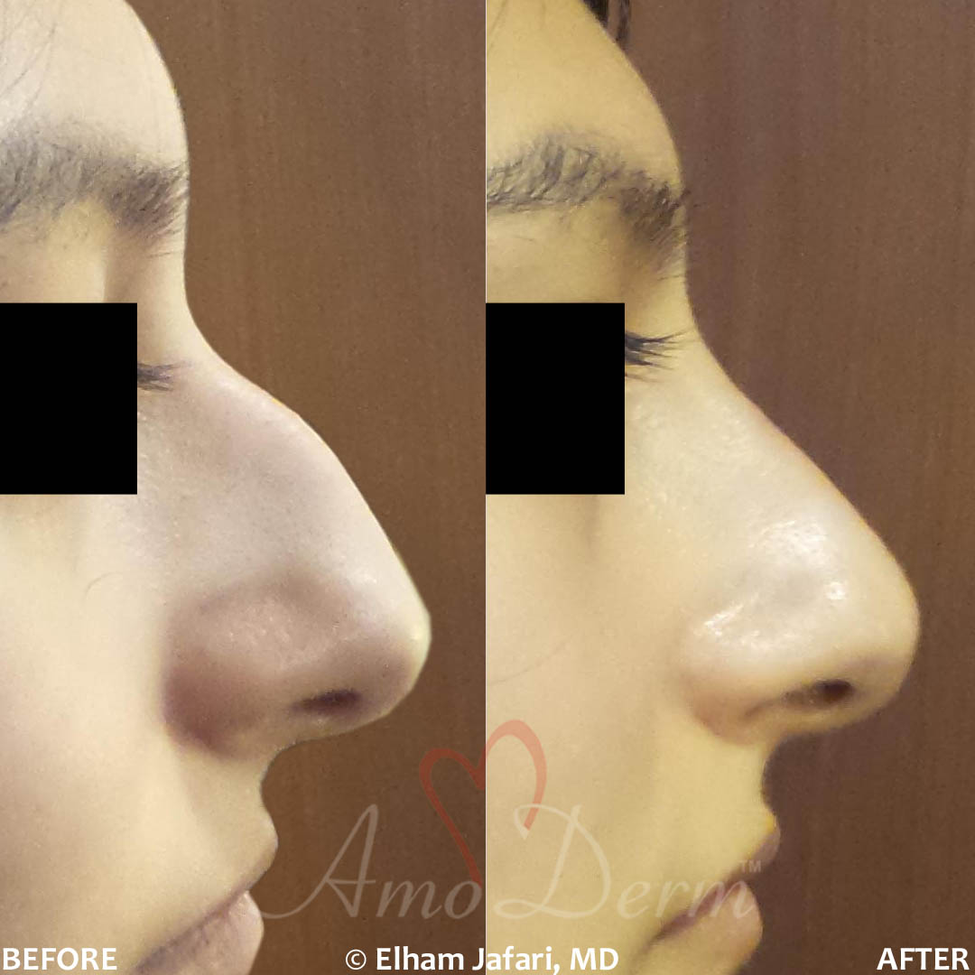 Nonsurgical nose job (liquid rhinoplasty)