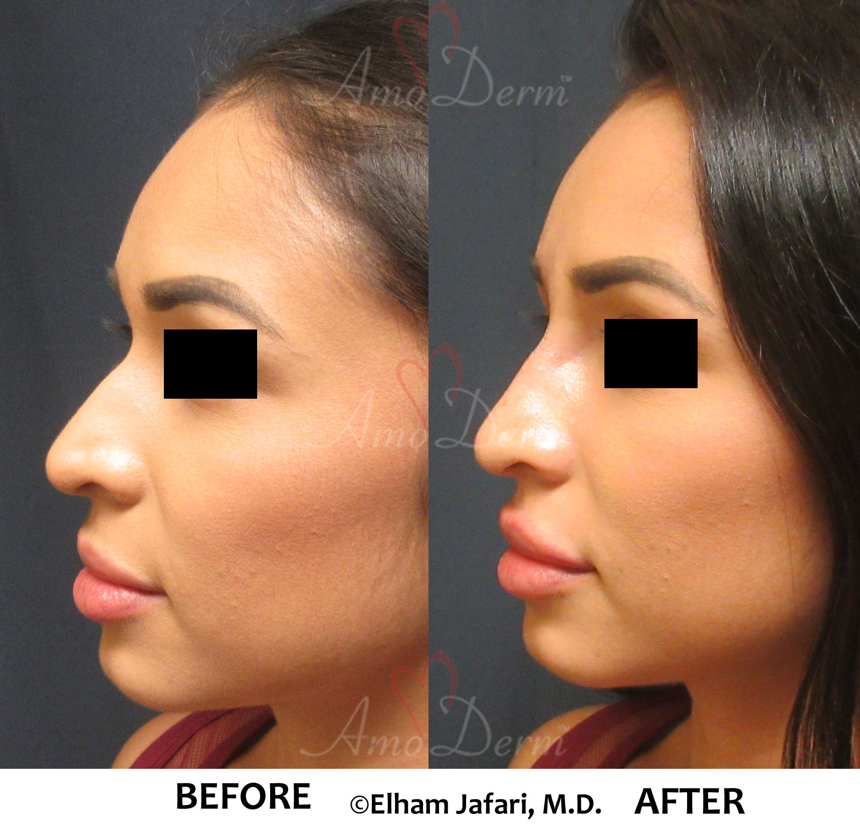 Nonsurgical Nose Job Cosmetic Treatments Before and After Pictures.