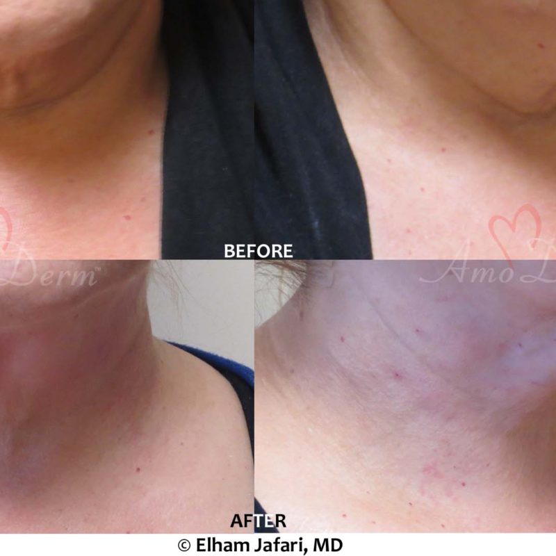 PDO Thread Lift Neck Lift