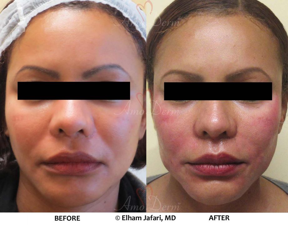 PDO Threadlift