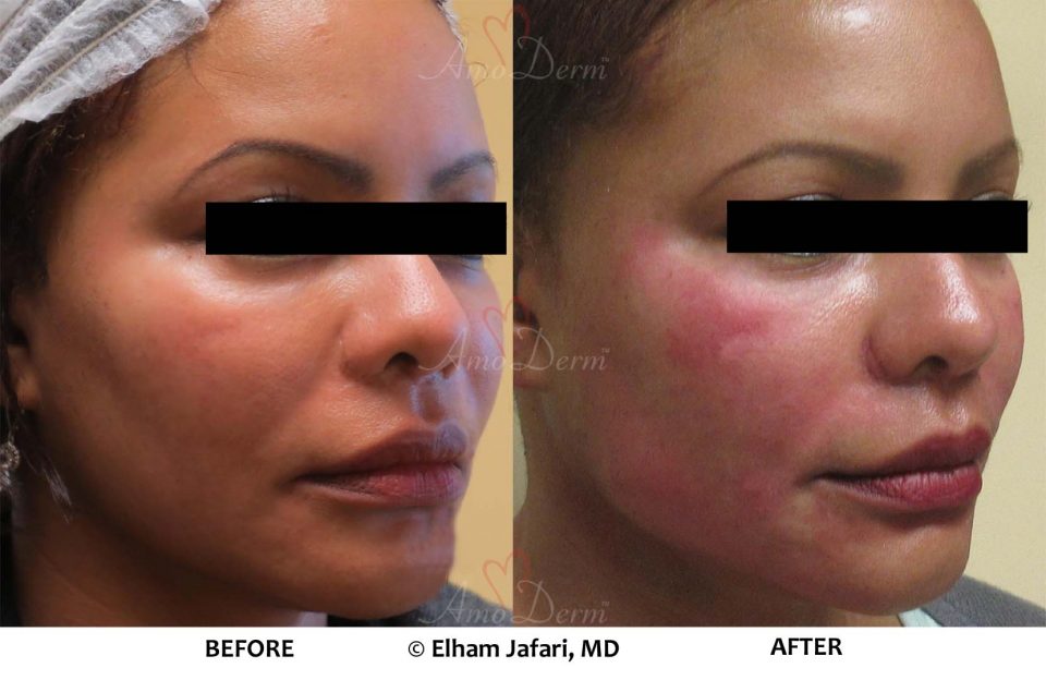 PDO Threadlift
