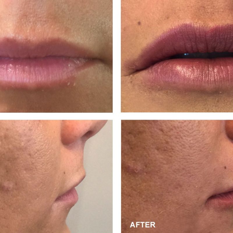 PDO Threading Lip Augmentation Cosmetic Treatments Before and After Pictures PDO Threading Lip Augmentation