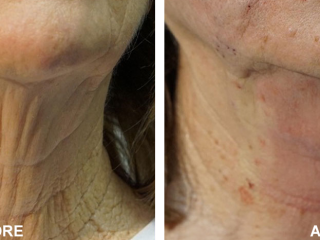 PDO Threading and Neck Rejuvenation