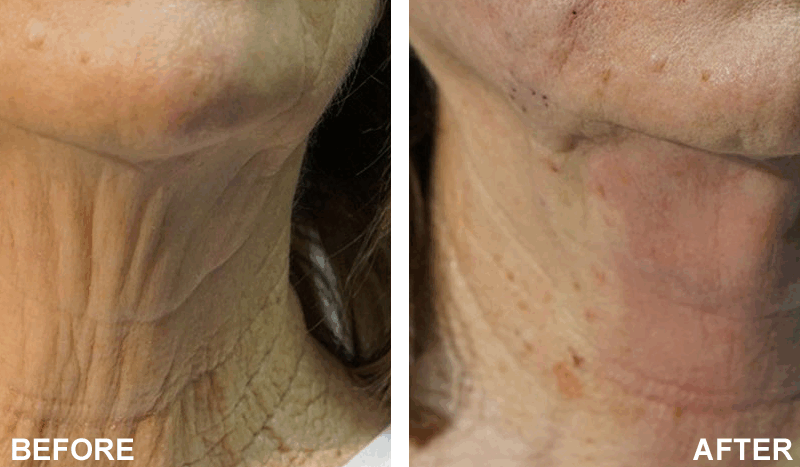 PDO Threading and Neck Rejuvenation