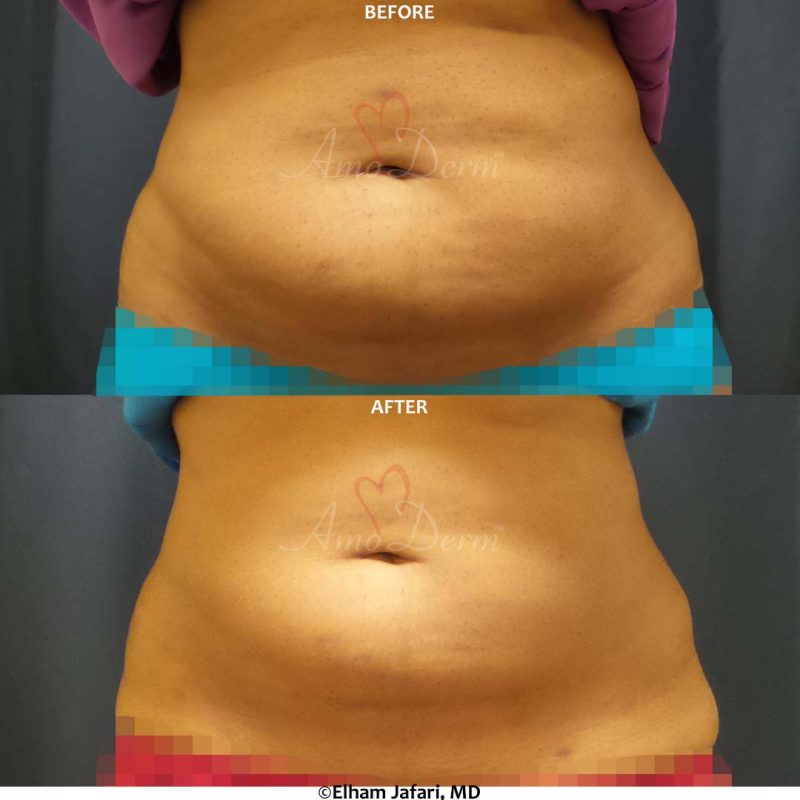 SculpSure