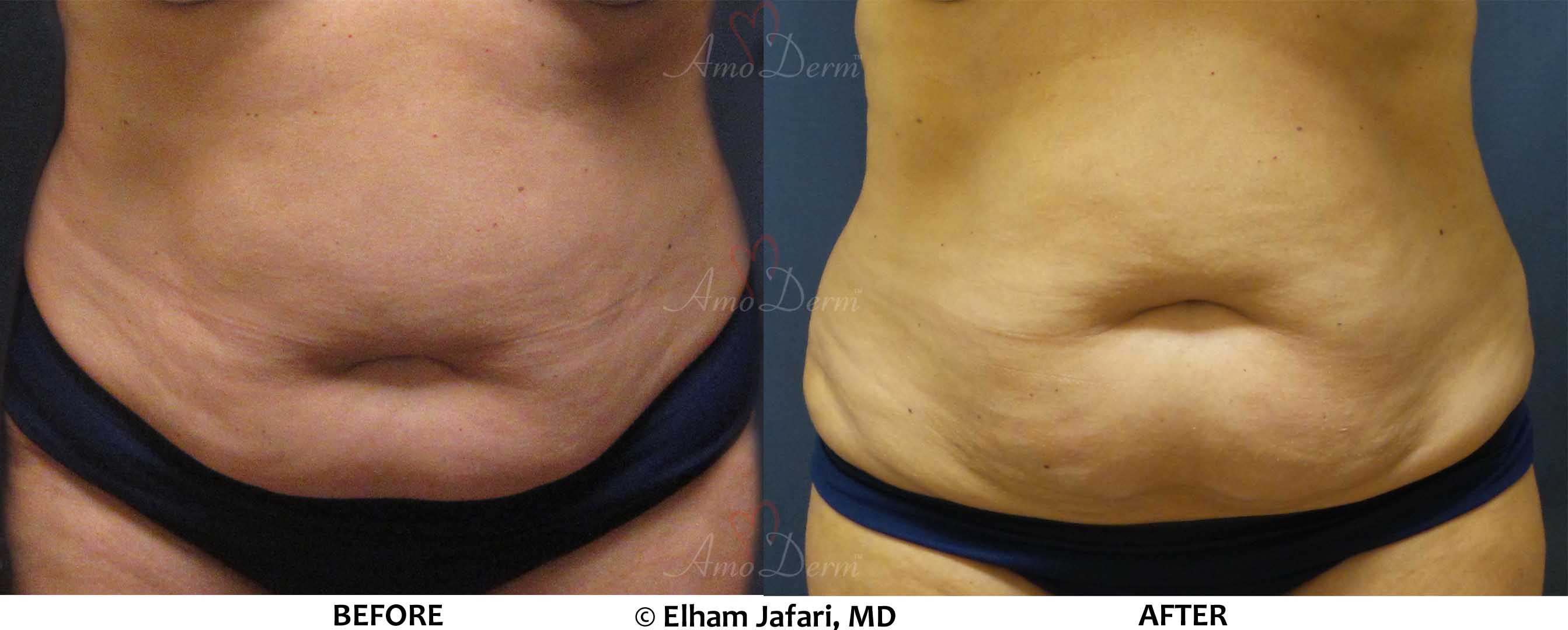 Venus Freeze Irvine Body Contouring Newport Beach Cellulite