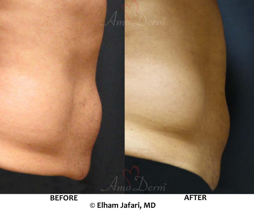 Venus Freeze Irvine Body Contouring Newport Beach Cellulite