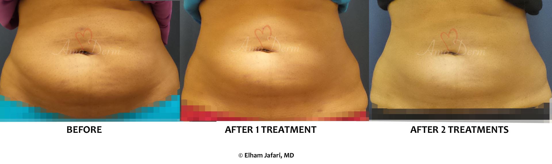 Venus Freeze Irvine Body Contouring Newport Beach Cellulite