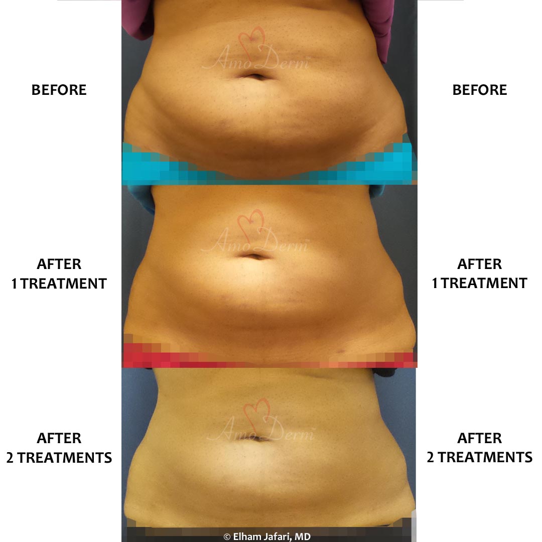 Venus Freeze Irvine Body Contouring Newport Beach Cellulite