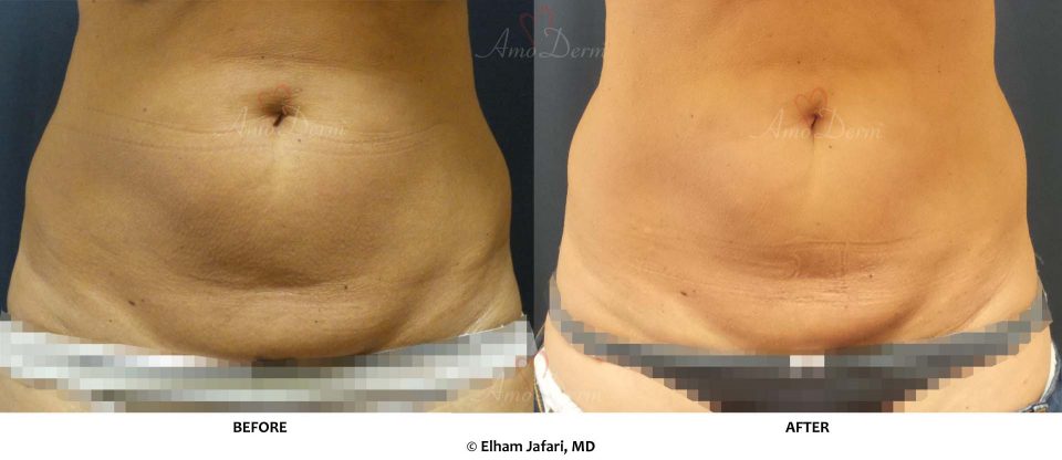 SculpSure