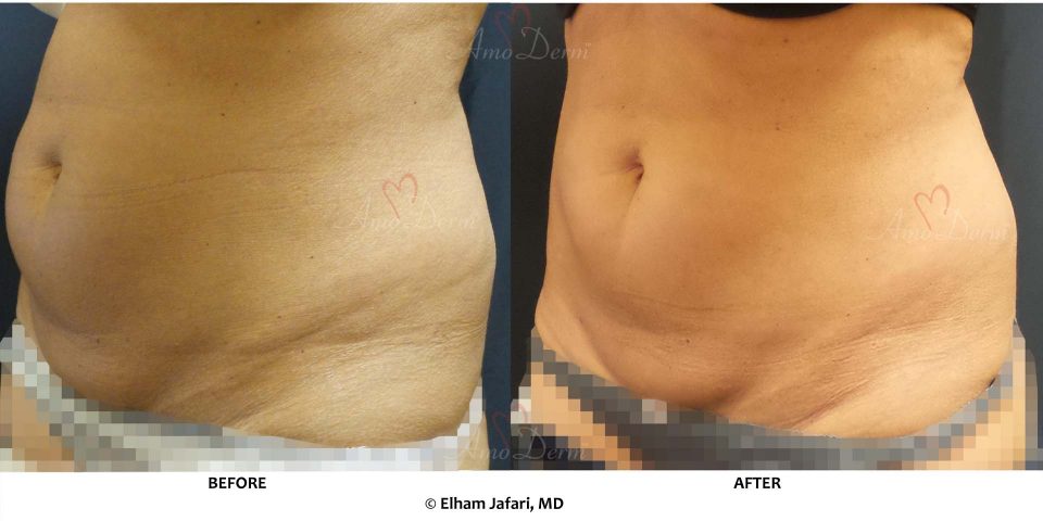 SculpSure