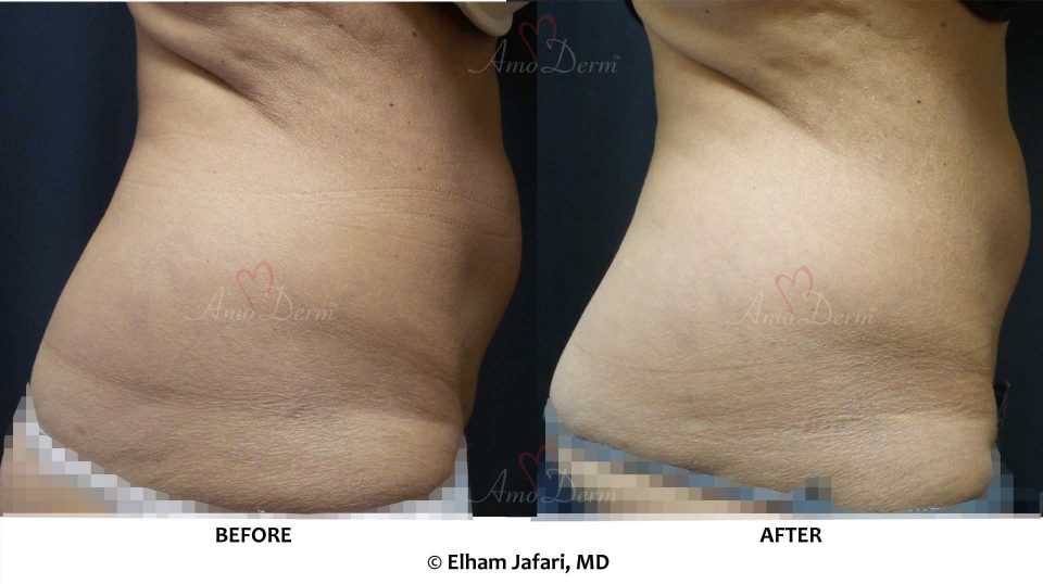SculpSure