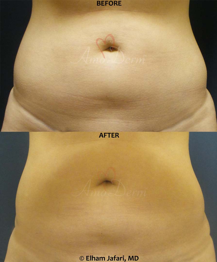 Venus Freeze Irvine Body Contouring Newport Beach Cellulite