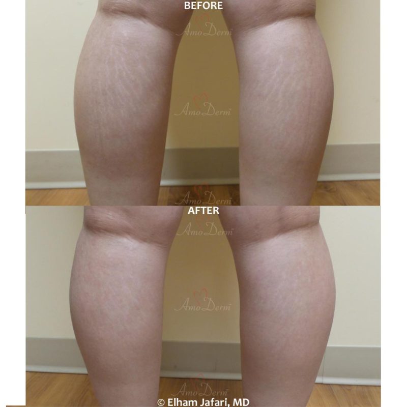 Stretch Marks - Before &amp; After Gallery Real Results at Amoderm