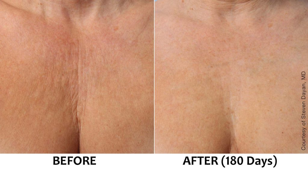 Wrinkles and lines on chest and décolletage area