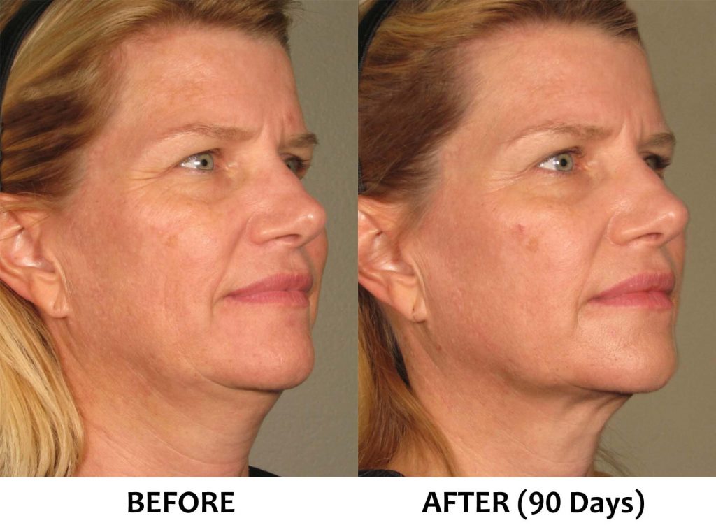 Ultherapy non surgical face lift FullFace