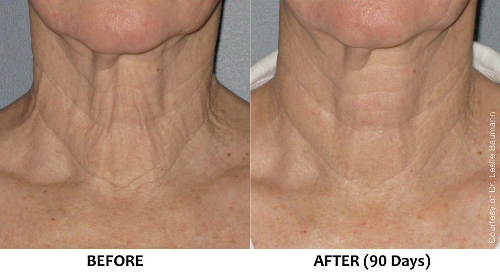 Loose and sagging skin on neck (non-surgical neck lift)