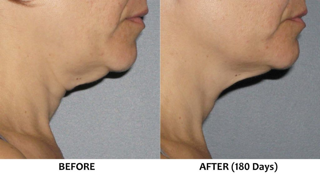 Loose and sagging skin under the chin (sub-mental area)