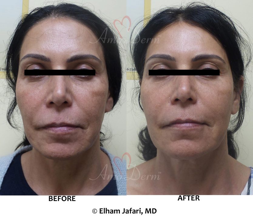 Chemical Peel (VI Peel) for skin rejuvenation and treatment of fine lines and skin pigmentation (dark or brown spots)
