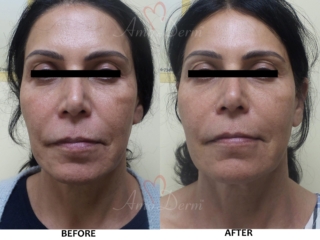Vi Peel Cosmetic Treatments Before and After Pictures Chemical Peel (VI Peel) for skin rejuvenation and treatment of fine lines and skin pigmentation (dark or brown spots)